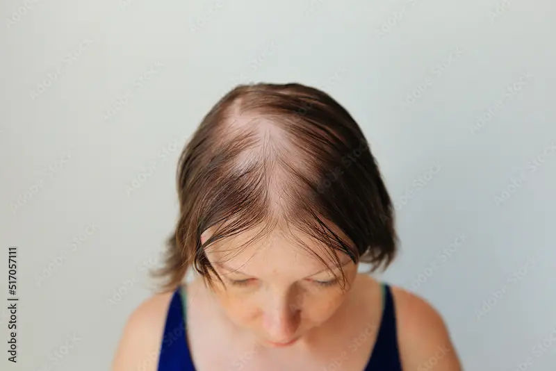 Alopecia Areata Overview Causes, Symptoms, Treatment
